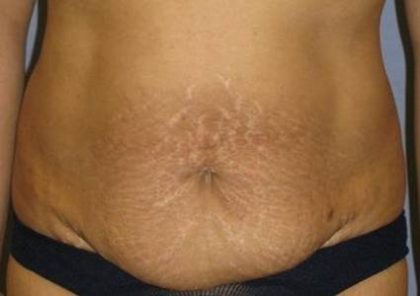 Tummy Tuck Before & After Patient #1231