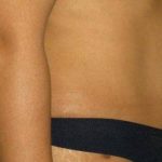 Tummy Tuck Before & After Patient #1231