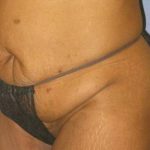 Tummy Tuck Before & After Patient #1241