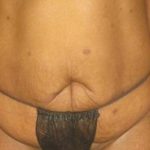 Tummy Tuck Before & After Patient #1241