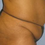 Tummy Tuck Before & After Patient #1241