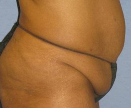 Tummy Tuck Before & After Patient #1241