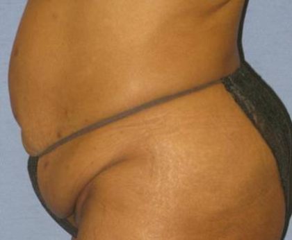 Tummy Tuck Before & After Patient #1241