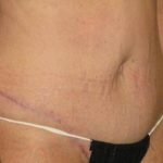 Tummy Tuck Before & After Patient #1250
