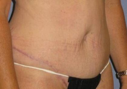 Tummy Tuck Before & After Patient #1250