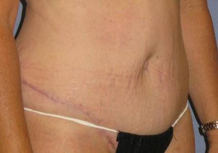 Tummy Tuck Before & After Patient #1250