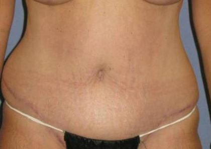 Tummy Tuck Before & After Patient #1250