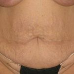 Tummy Tuck Before & After Patient #1250