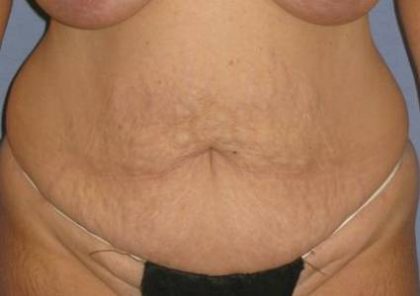 Tummy Tuck Before & After Patient #1250