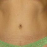 Tummy Tuck Before & After Patient #1255