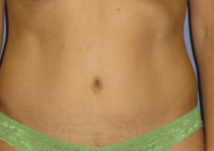 Tummy Tuck Before & After Patient #1255