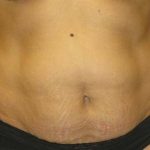 Tummy Tuck Before & After Patient #1255