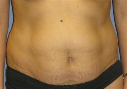 Tummy Tuck Before & After Patient #1255