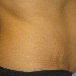 Tummy Tuck Before & After Patient #1255