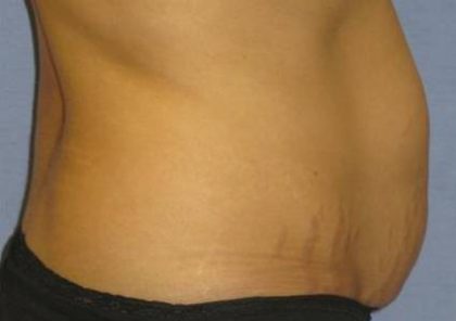 Tummy Tuck Before & After Patient #1255