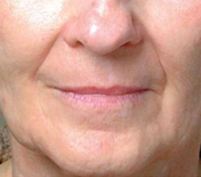 Laser Skin Resurfacing Before & After Patient #1787