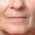 Laser Skin Resurfacing Before & After Patient #1787