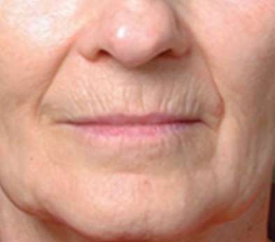 Laser Skin Resurfacing Before & After Patient #1787