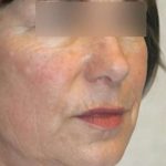 Laser Skin Resurfacing Before & After Patient #1790