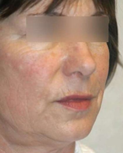 Laser Skin Resurfacing Before & After Patient #1790