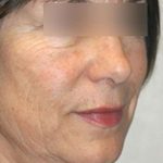 Laser Skin Resurfacing Before & After Patient #1790