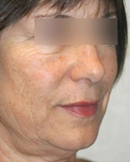 Laser Skin Resurfacing Before & After Patient #1790