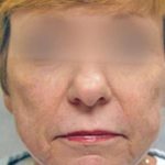 Laser Skin Resurfacing Before & After Patient #1793