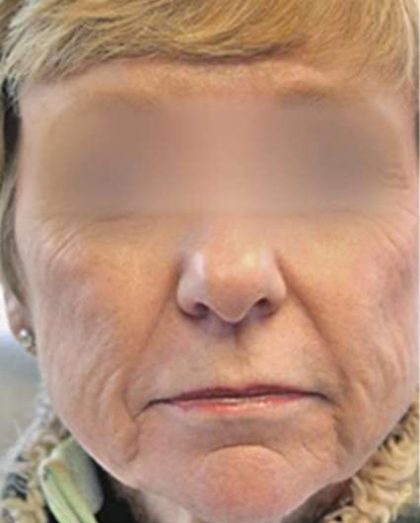 Laser Skin Resurfacing Before & After Patient #1793