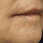 Laser Skin Resurfacing Before & After Patient #1796