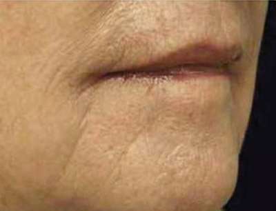 Laser Skin Resurfacing Before & After Patient #1796