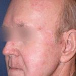 Laser Skin Resurfacing Before & After Patient #1808