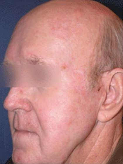 Laser Skin Resurfacing Before & After Patient #1808