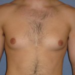 Gynecomastia for Men Before & After Patient #1424