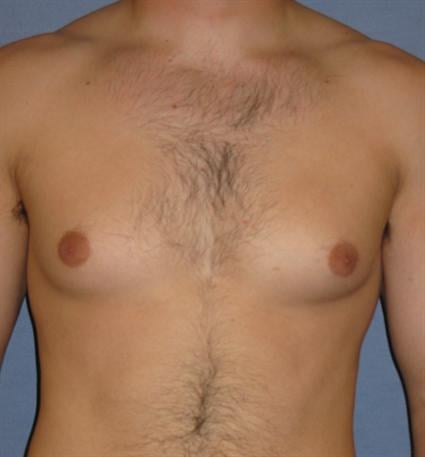 Gynecomastia for Men Before & After Patient #1424