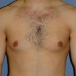 Gynecomastia for Men Before & After Patient #1424