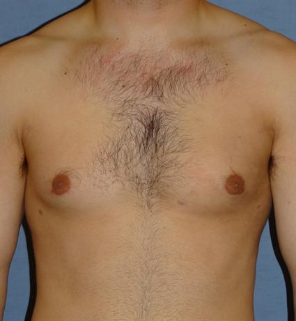 Gynecomastia for Men Before & After Patient #1424