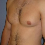 Gynecomastia for Men Before & After Patient #1424