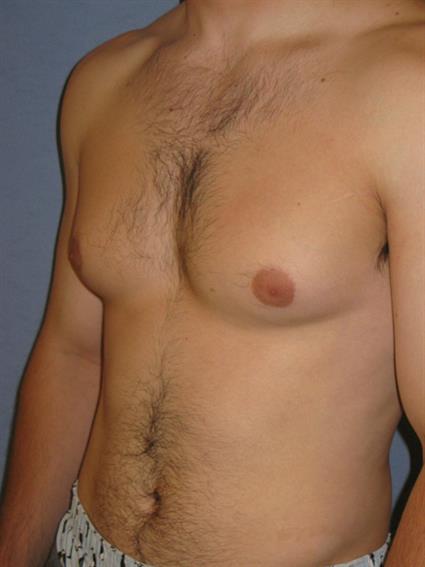 Gynecomastia for Men Before & After Patient #1424