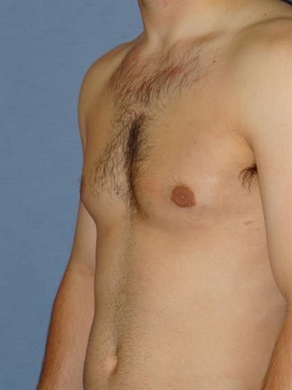 Gynecomastia for Men Before & After Patient #1424