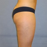 Liposuction Before & After Patient #1025