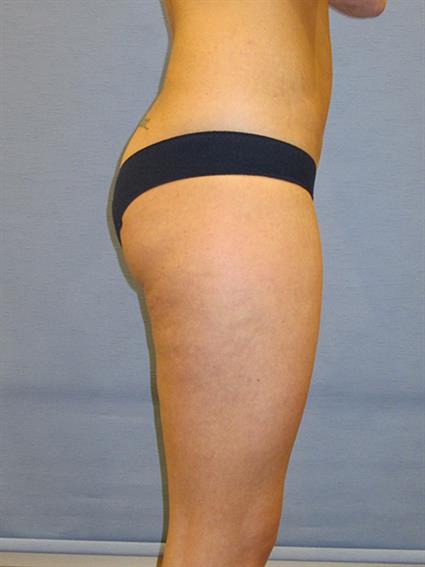 Liposuction Before & After Patient #1025