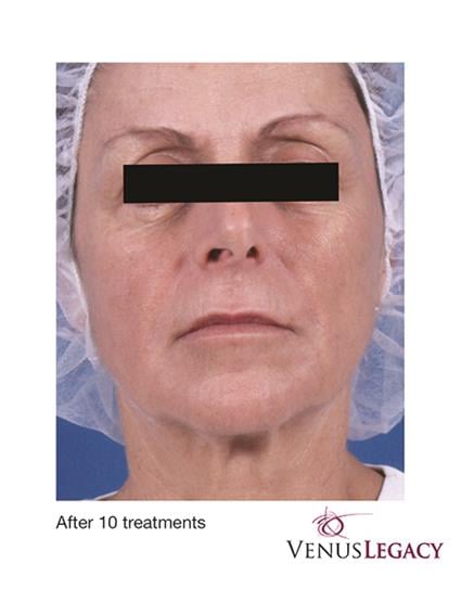 Venus Legacy Before & After Patient #1826