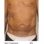 Venus Legacy Before & After Patient #1817