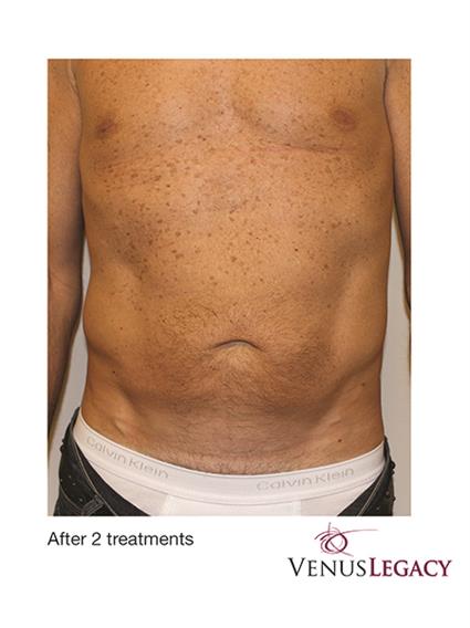 Venus Legacy Before & After Patient #1817