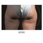 CoolSculpting Before & After Patient #1022