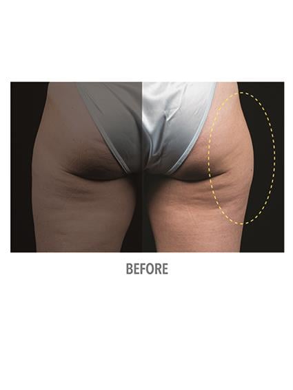 CoolSculpting Before & After Patient #1022