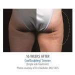 CoolSculpting Before & After Patient #1022