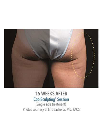 CoolSculpting Before & After Patient #1022