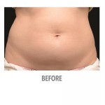 CoolSculpting Before & After Patient #1019