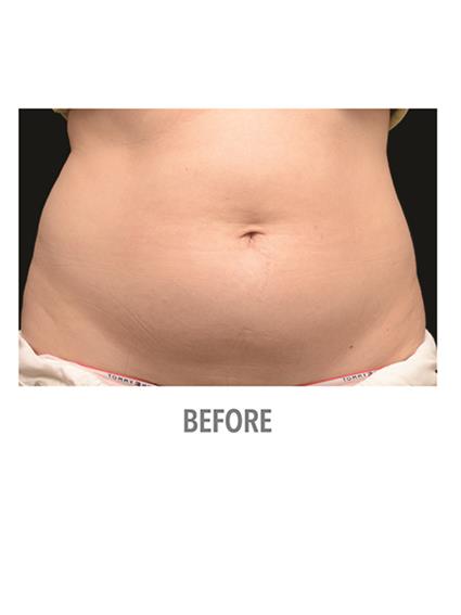 CoolSculpting Before & After Patient #1019